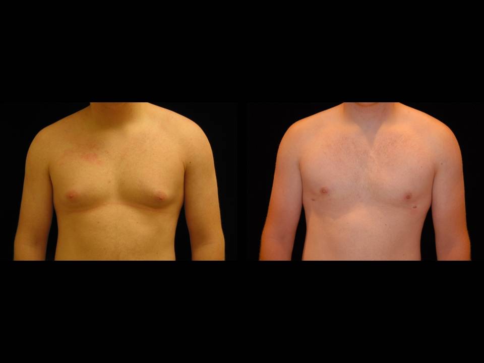 Gynecomastia Before and After | Premier Plastic Surgery