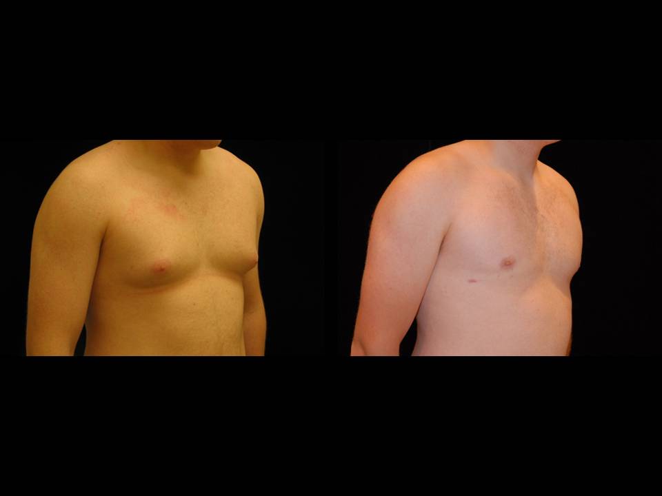 Gynecomastia Before and After | Premier Plastic Surgery