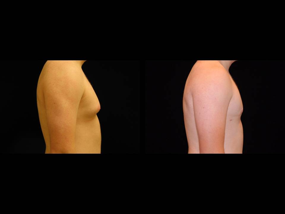 Gynecomastia Before and After | Premier Plastic Surgery