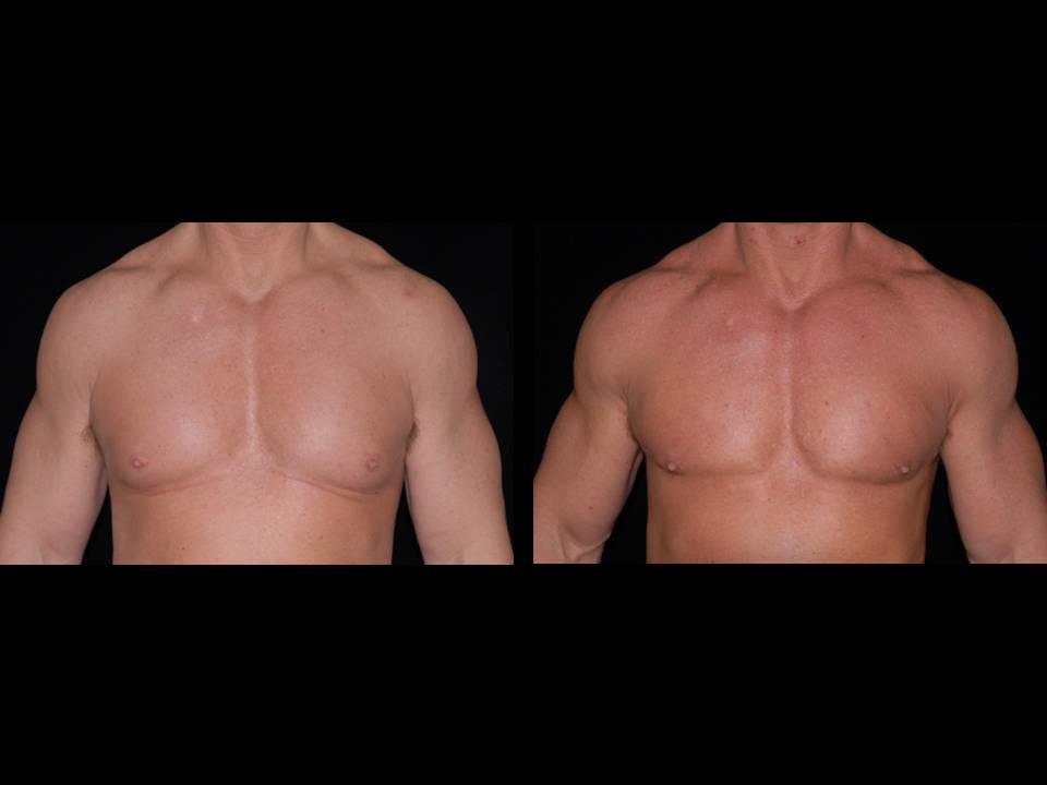 Gynecomastia Before and After | Premier Plastic Surgery