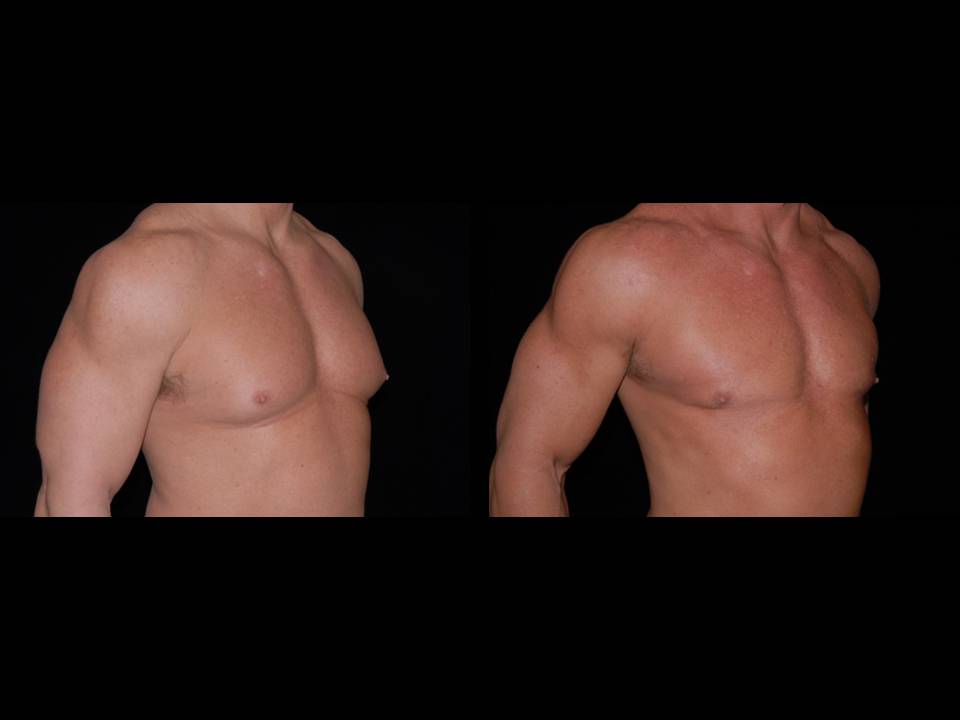 Gynecomastia Before and After | Premier Plastic Surgery