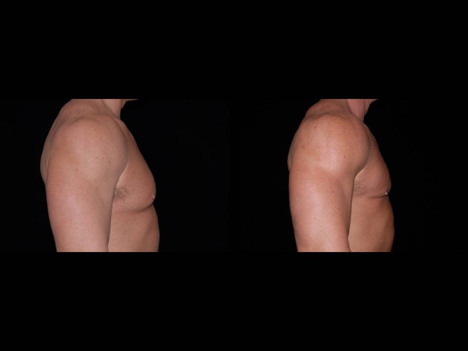 Gynecomastia Before and After | Premier Plastic Surgery