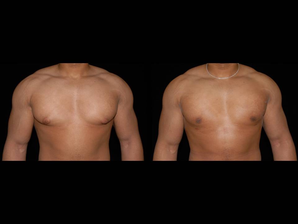 Gynecomastia Before and After | Premier Plastic Surgery