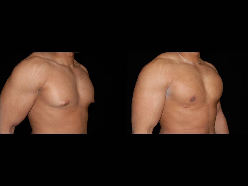 Gynecomastia Before and After | Premier Plastic Surgery