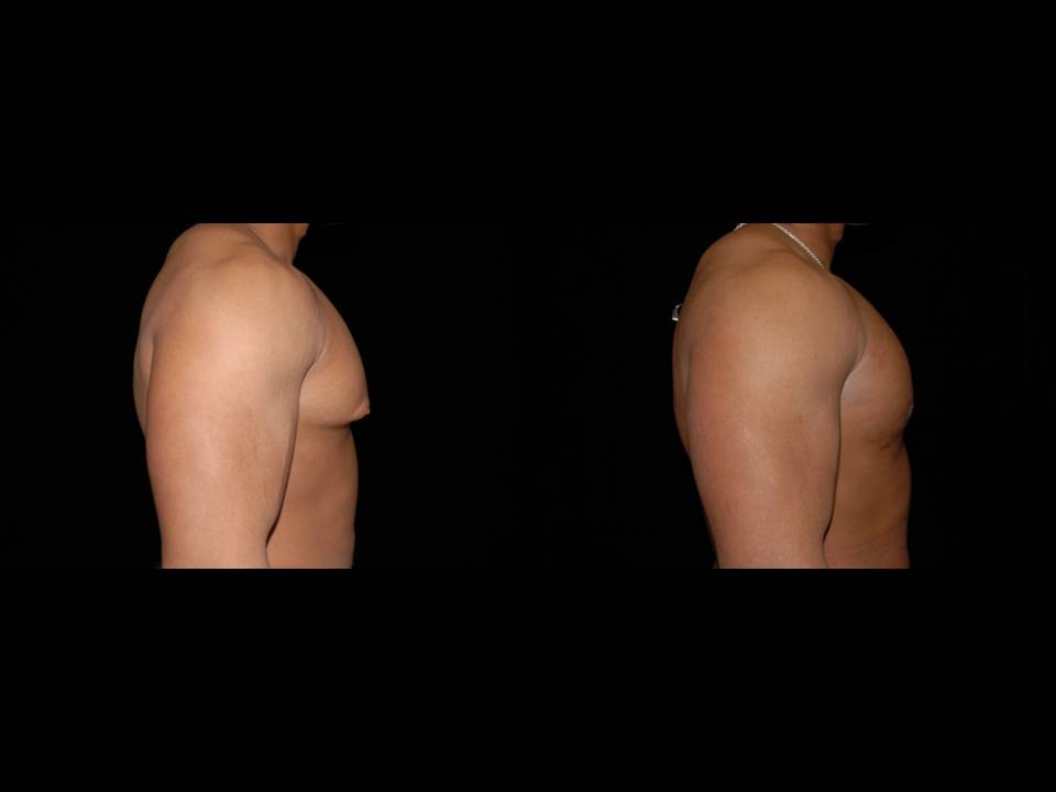 Gynecomastia Before and After | Premier Plastic Surgery