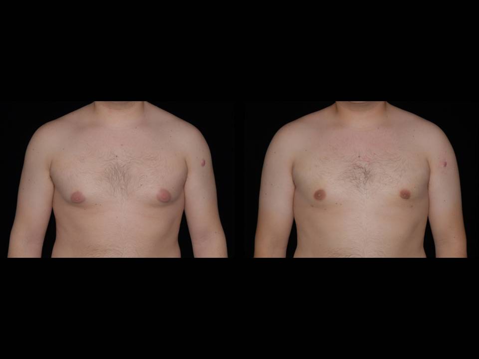 Gynecomastia Before and After | Premier Plastic Surgery