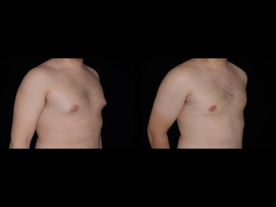 Gynecomastia Before and After | Premier Plastic Surgery