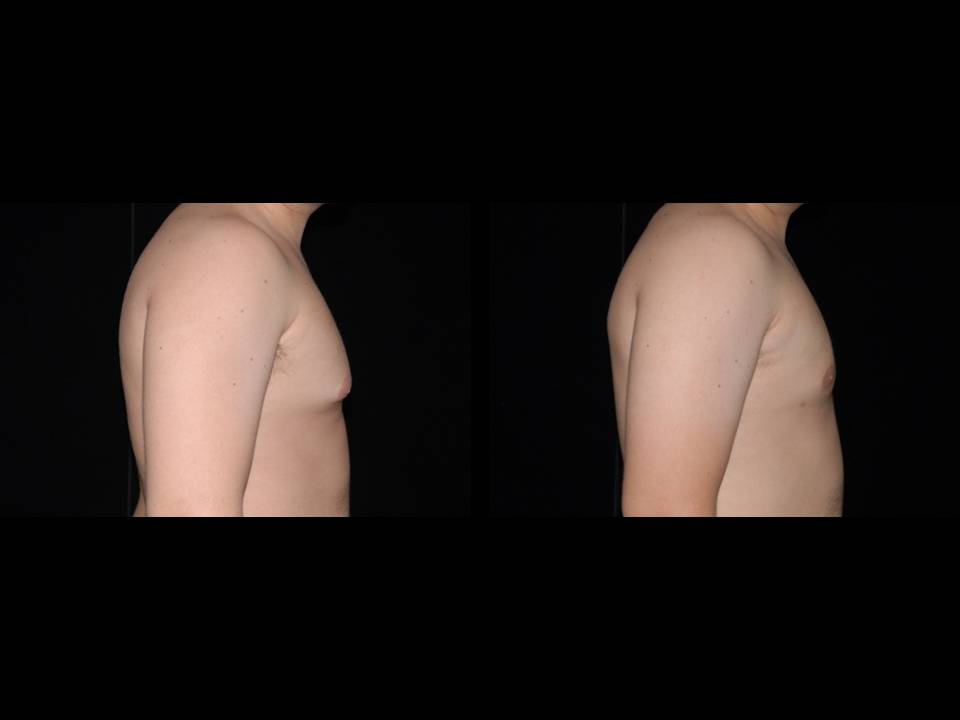 Gynecomastia Before and After | Premier Plastic Surgery