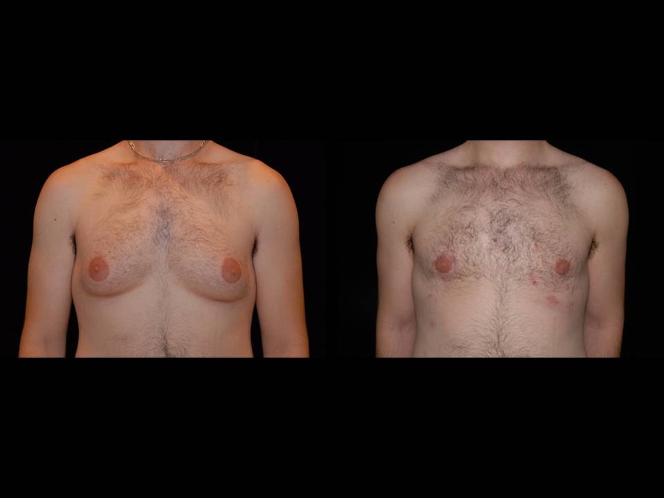 Gynecomastia Before and After | Premier Plastic Surgery