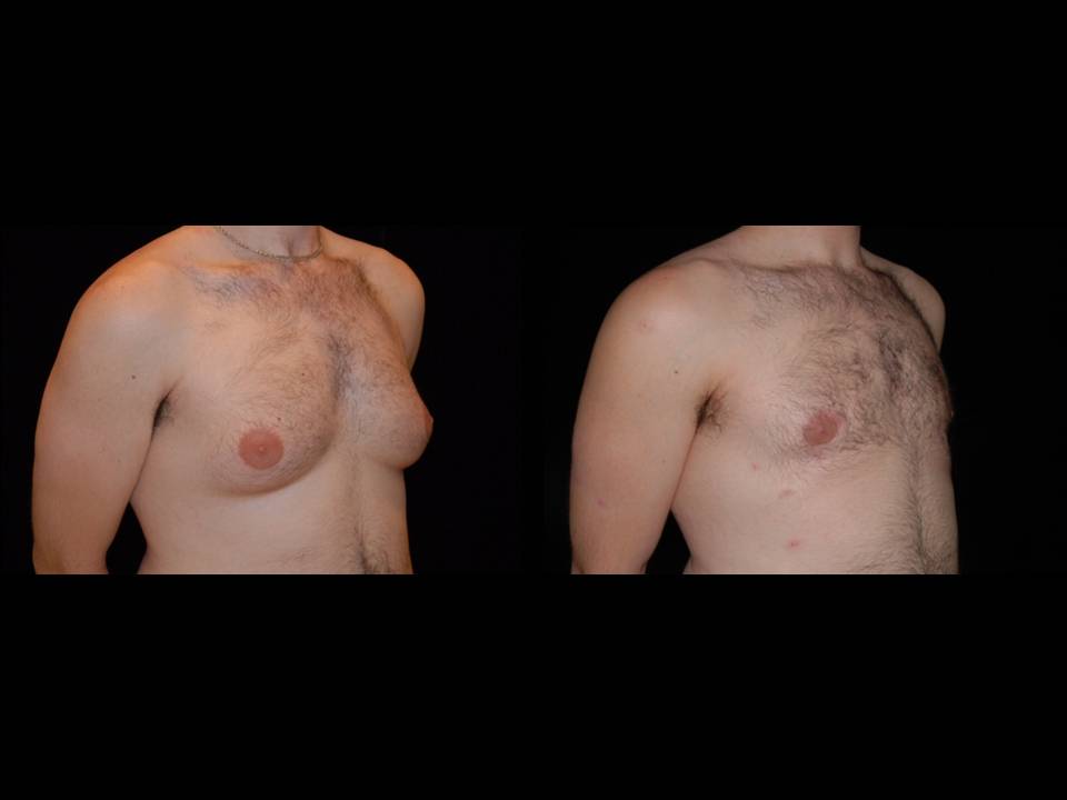 Gynecomastia Before and After | Premier Plastic Surgery