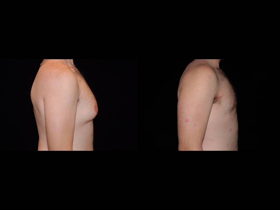 Gynecomastia Before and After | Premier Plastic Surgery