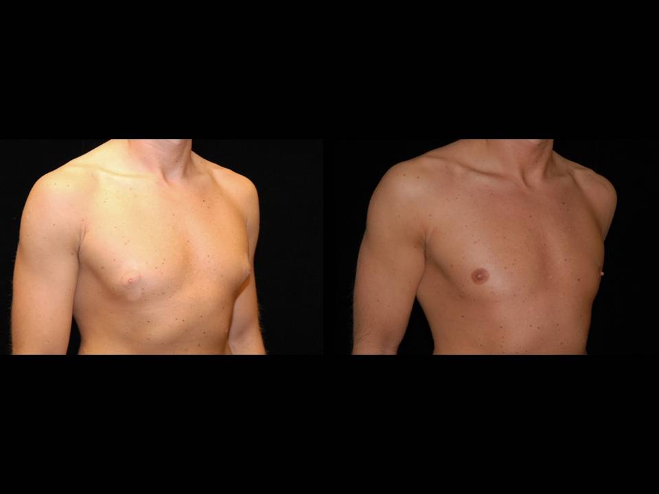 Gynecomastia Before and After | Premier Plastic Surgery