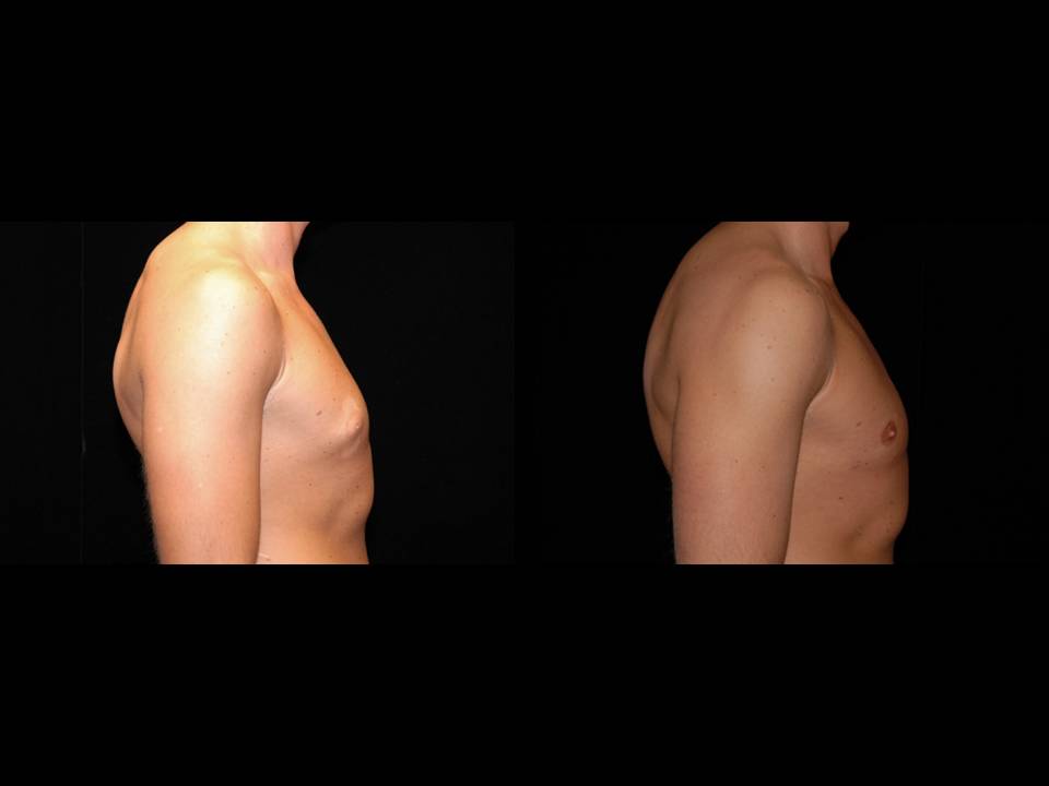 Gynecomastia Before and After | Premier Plastic Surgery