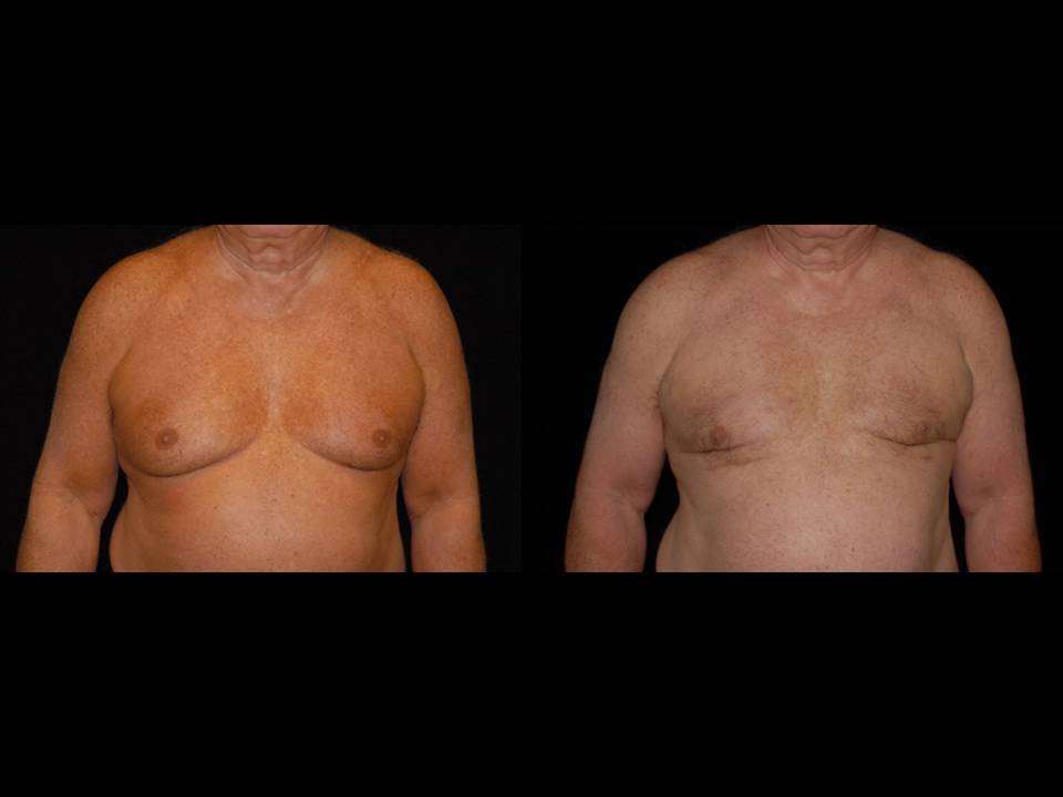 Gynecomastia Before and After | Premier Plastic Surgery