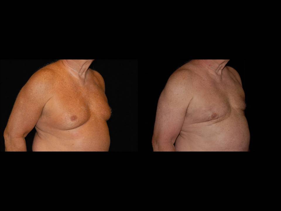 Gynecomastia Before and After | Premier Plastic Surgery