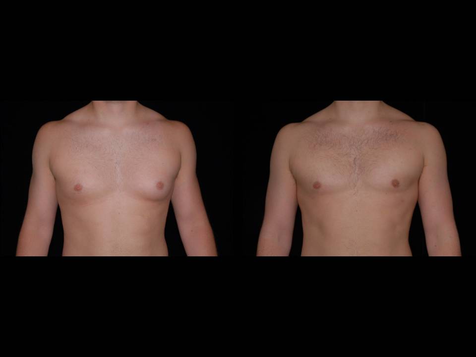 Gynecomastia Before and After | Premier Plastic Surgery