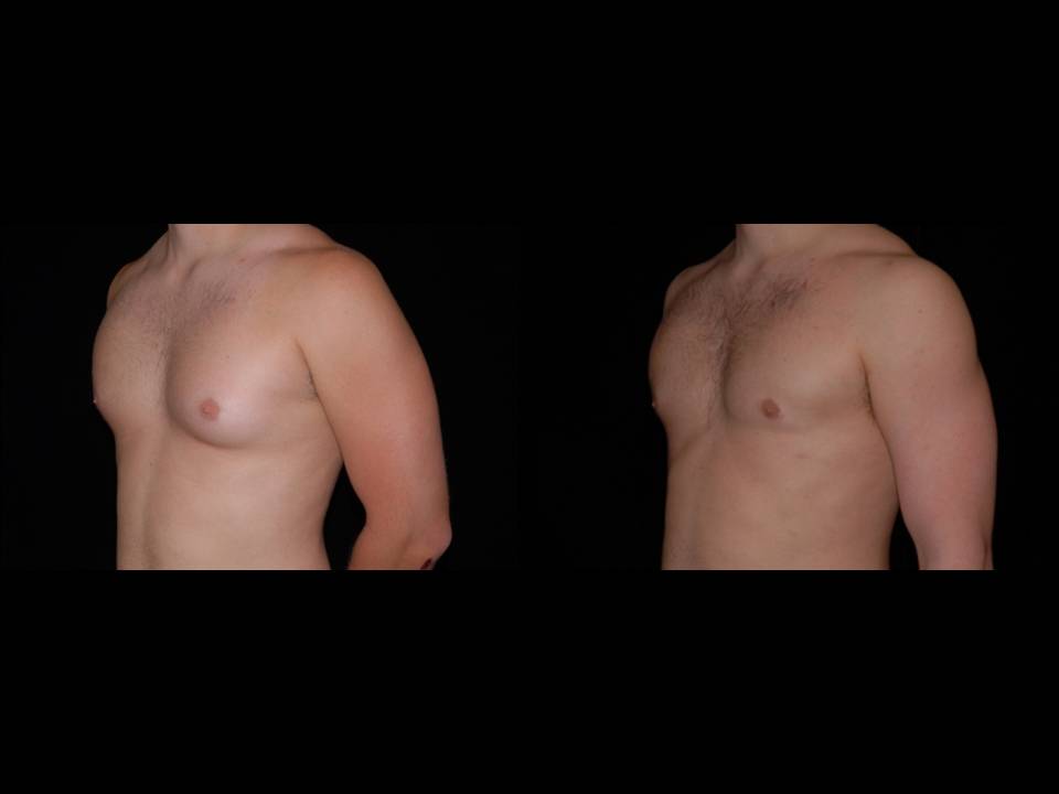 Gynecomastia Before and After | Premier Plastic Surgery