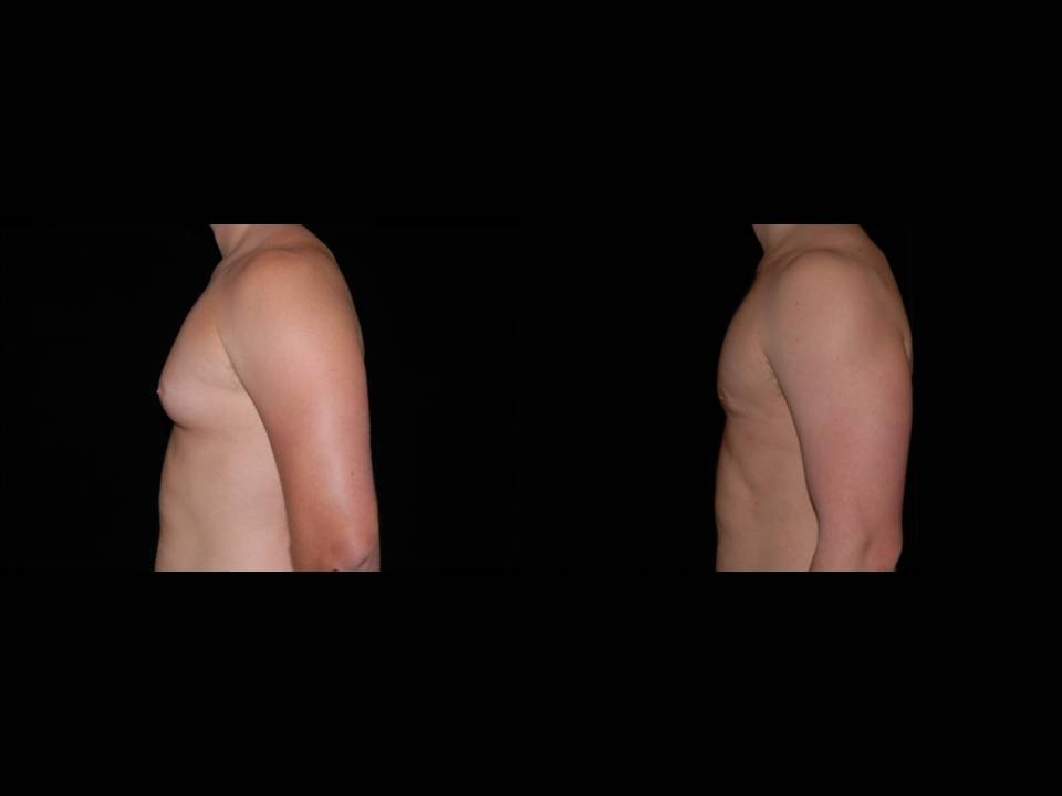 Gynecomastia Before and After | Premier Plastic Surgery