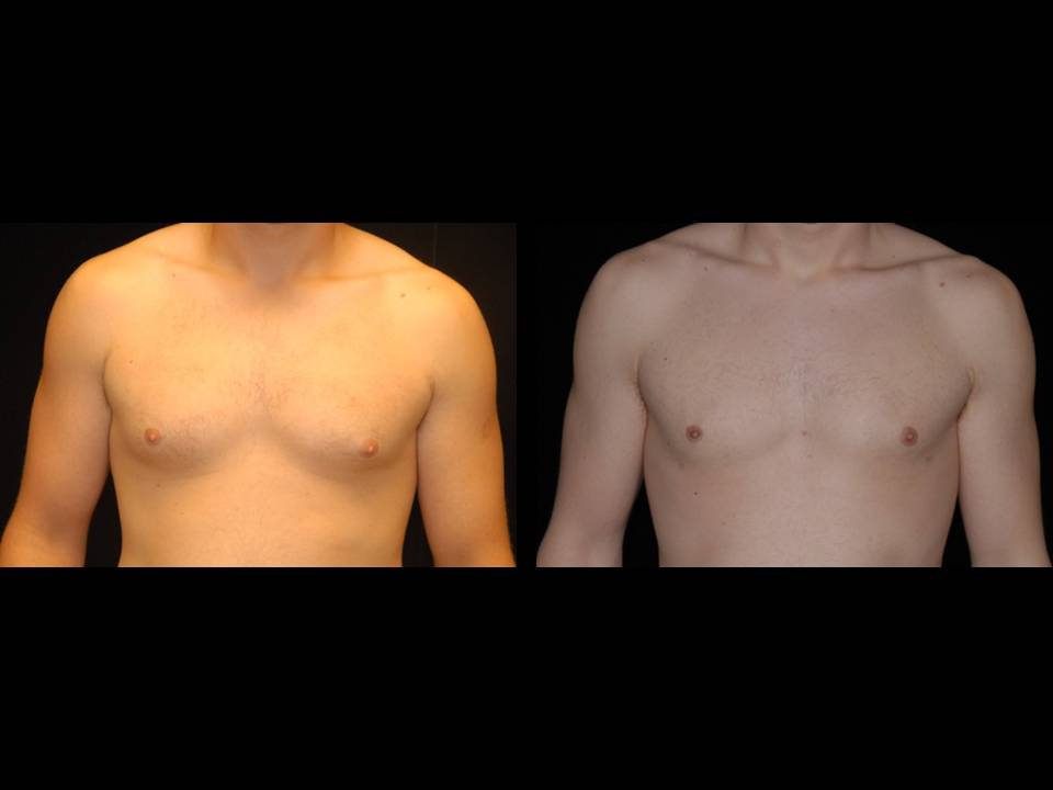 Gynecomastia Before and After | Premier Plastic Surgery