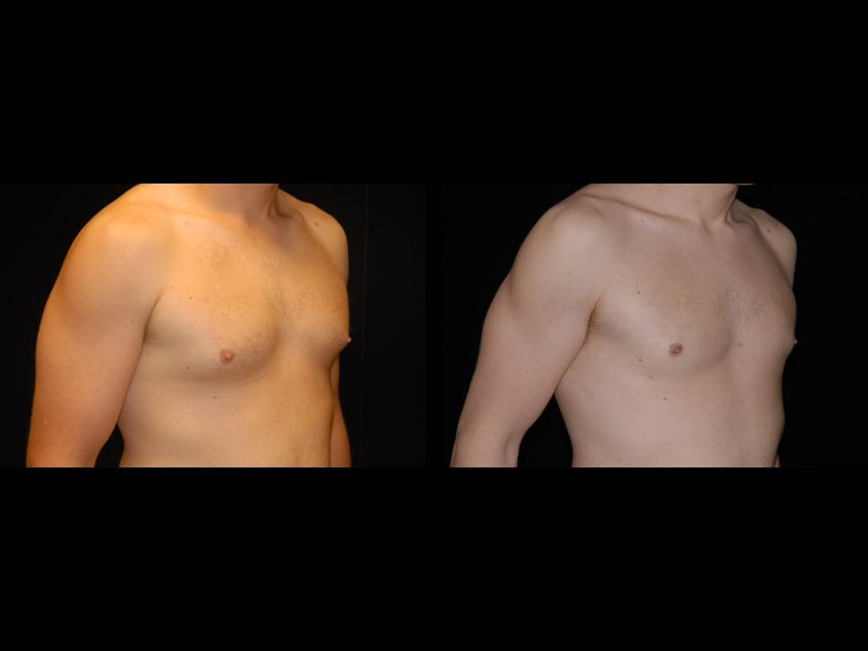 Gynecomastia Before and After | Premier Plastic Surgery