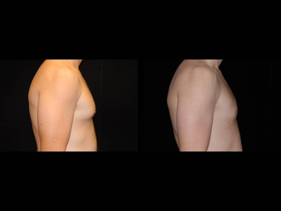 Gynecomastia Before and After | Premier Plastic Surgery