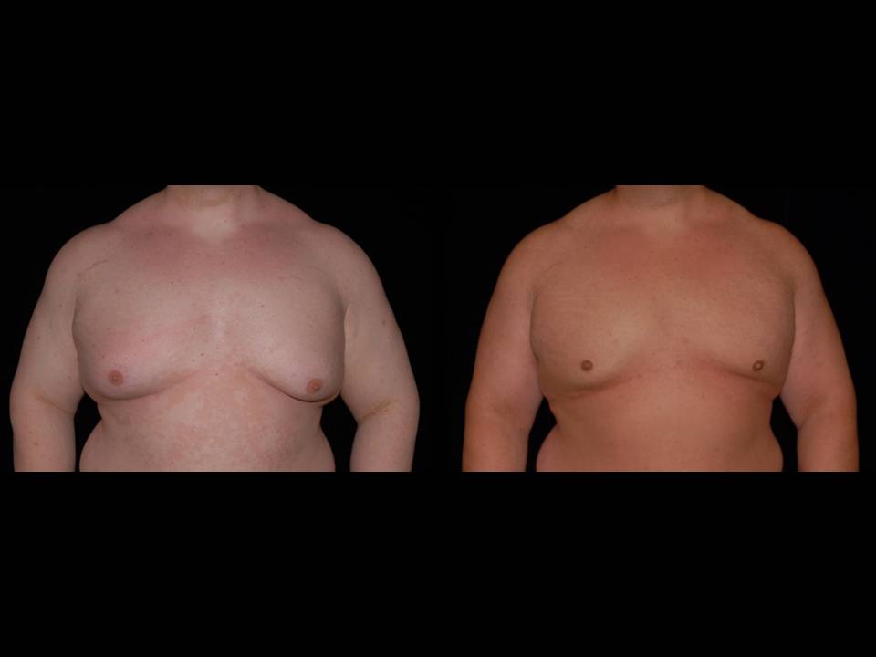 Gynecomastia Before and After | Premier Plastic Surgery