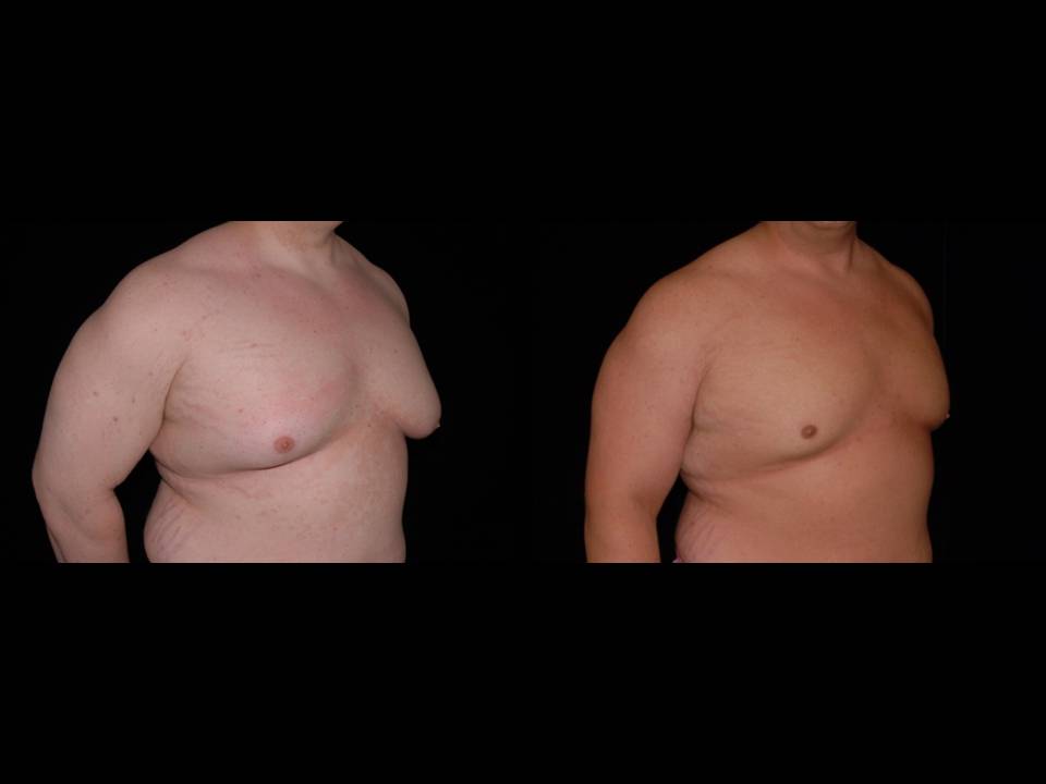 Gynecomastia Before and After | Premier Plastic Surgery