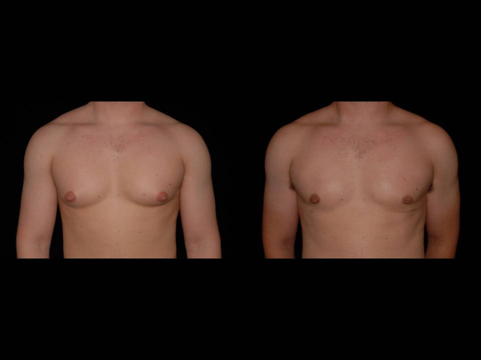 Gynecomastia Before and After | Premier Plastic Surgery