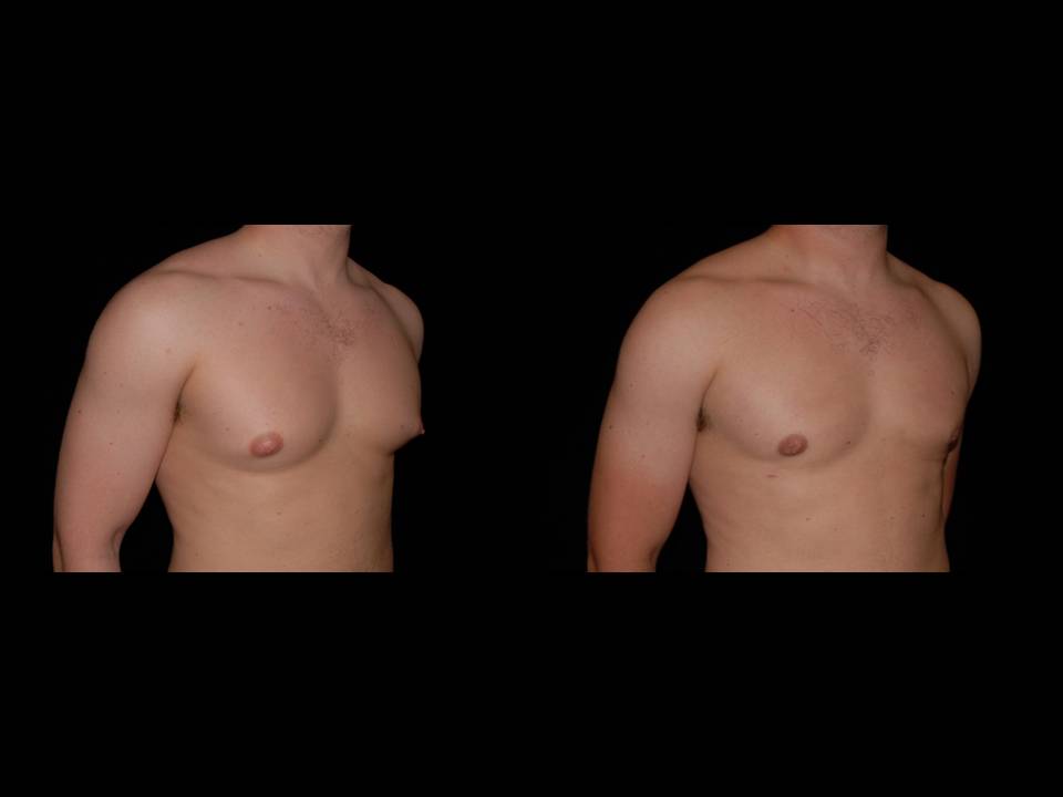 Gynecomastia Before and After | Premier Plastic Surgery