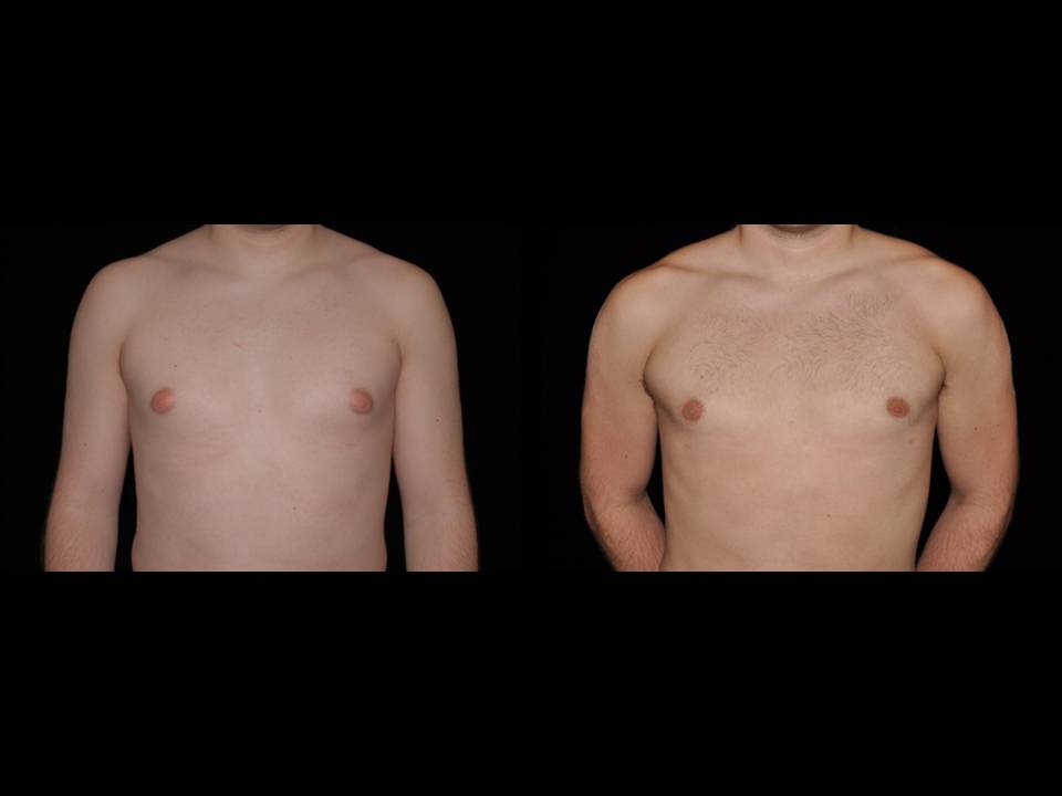 Gynecomastia Before and After | Premier Plastic Surgery