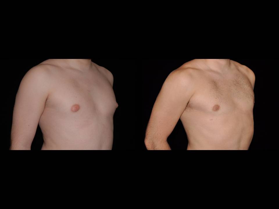 Gynecomastia Before and After | Premier Plastic Surgery