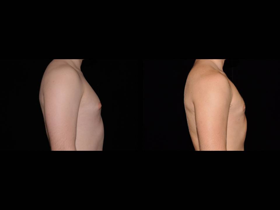 Gynecomastia Before and After | Premier Plastic Surgery