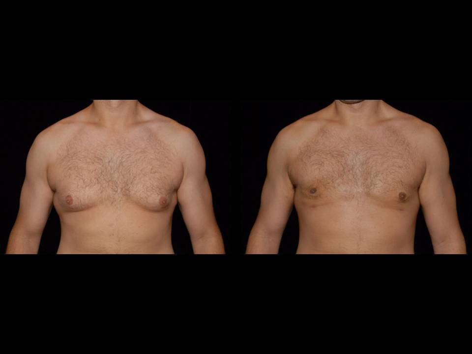 Gynecomastia Before and After | Premier Plastic Surgery