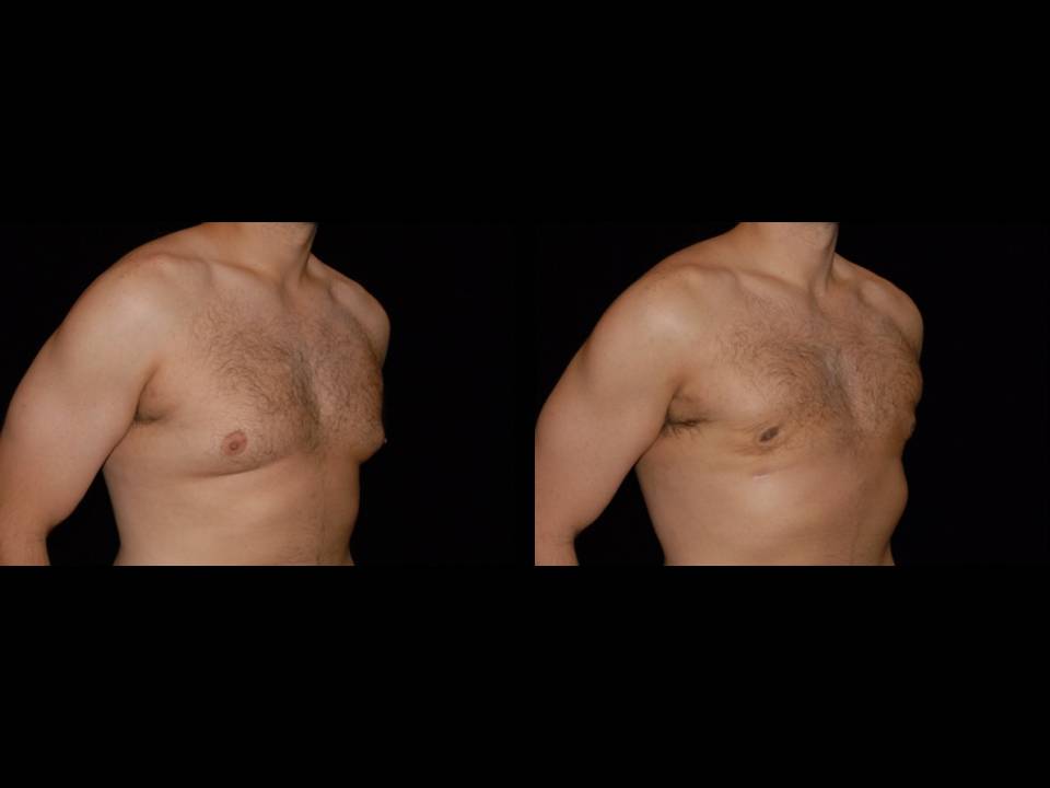 Gynecomastia Before and After | Premier Plastic Surgery