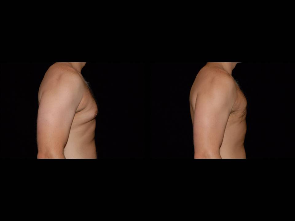 Gynecomastia Before and After | Premier Plastic Surgery