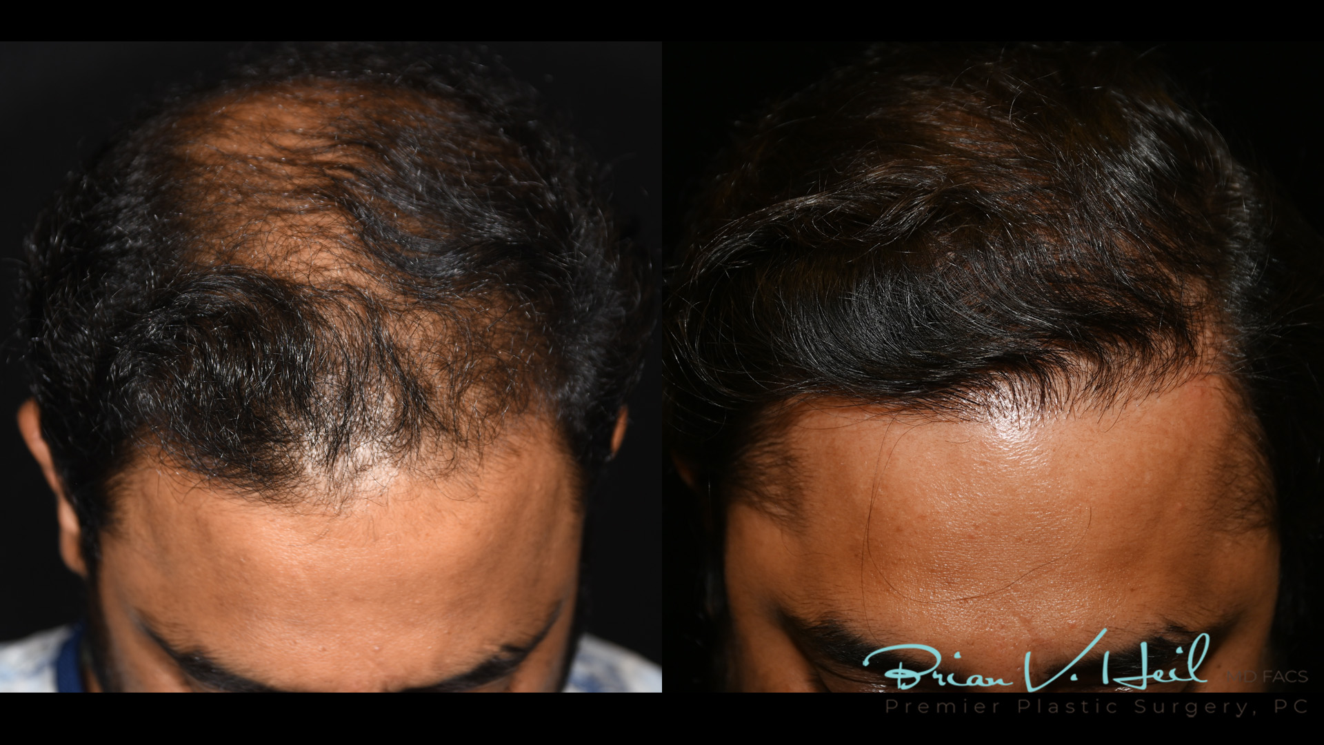 Hair Restoration Before and After | Premier Plastic Surgery