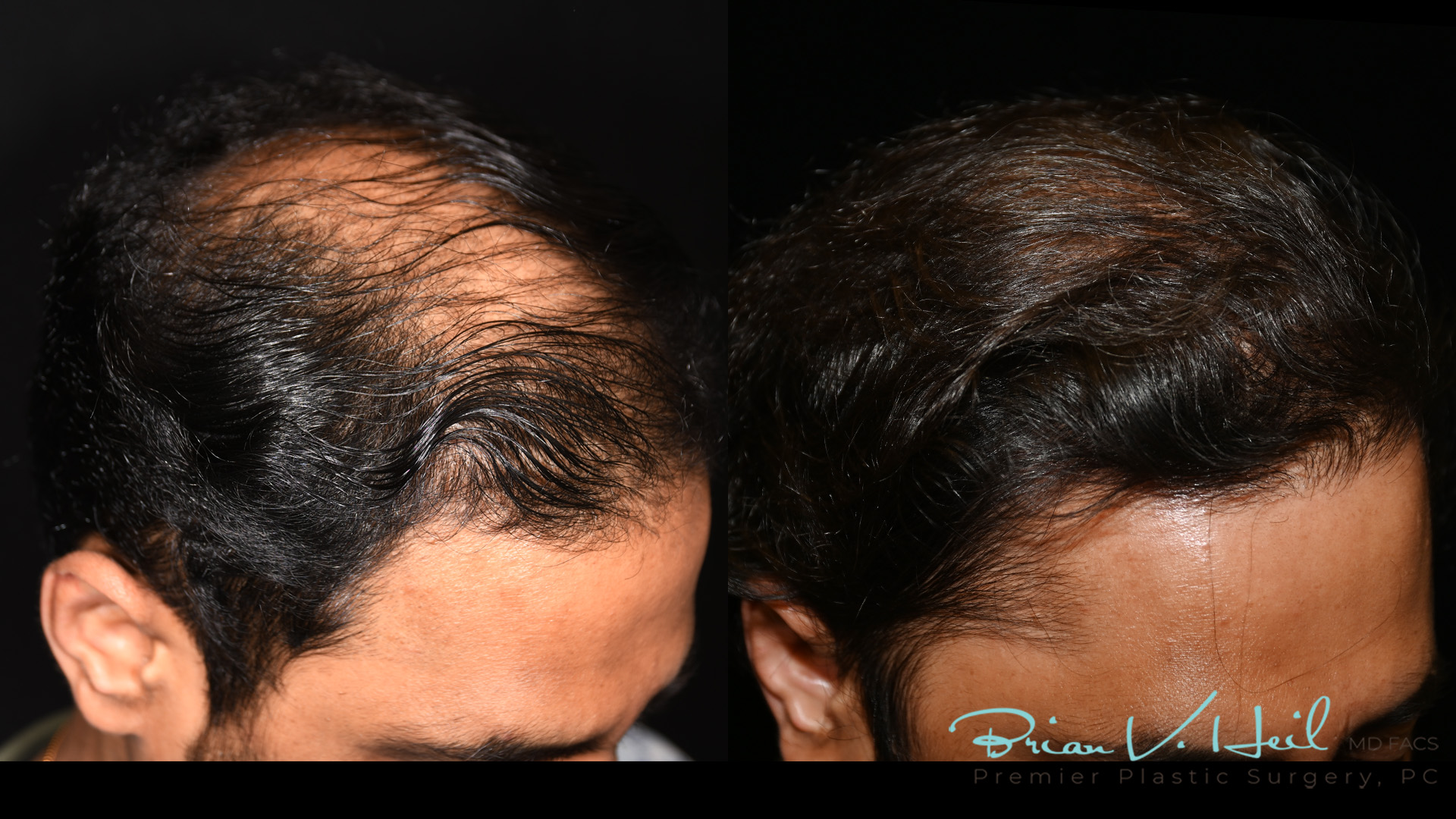 Hair Restoration Before and After | Premier Plastic Surgery