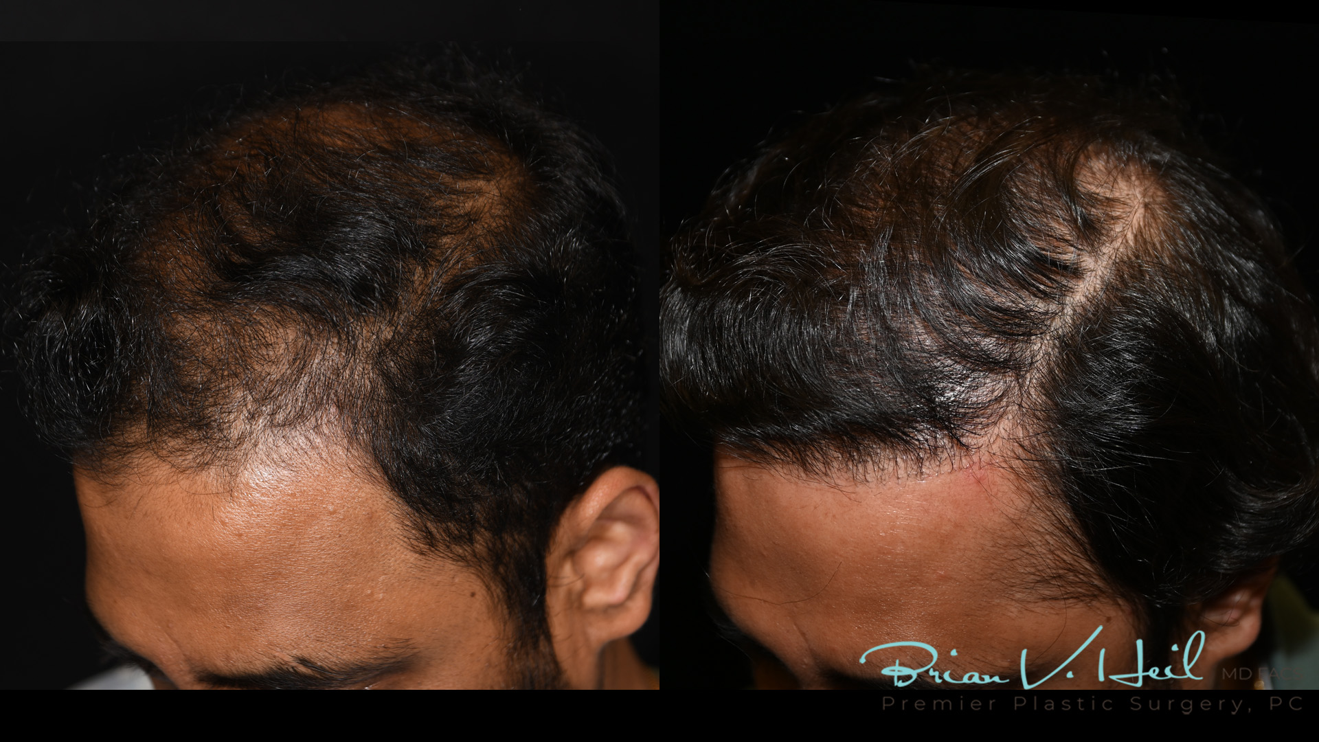 Hair Restoration Before and After | Premier Plastic Surgery