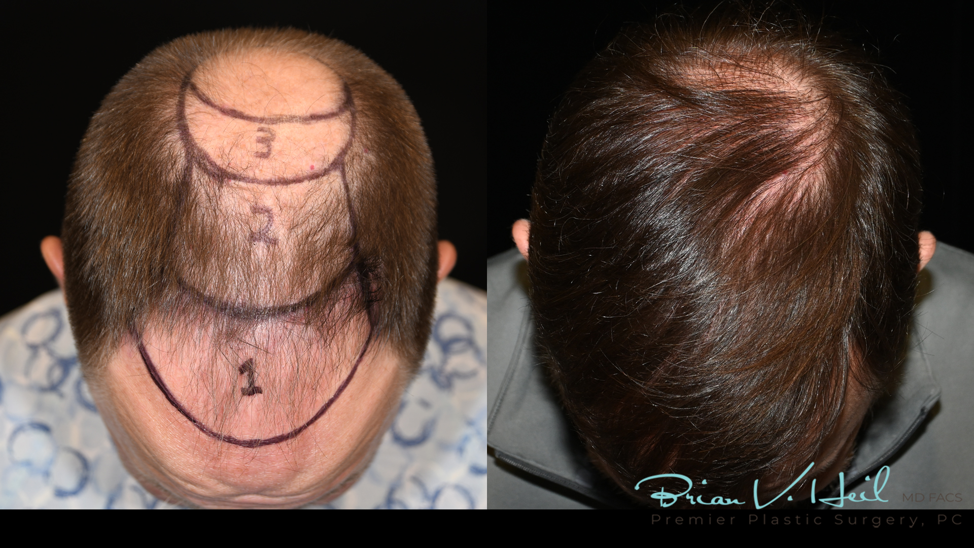 Hair Restoration Before and After | Premier Plastic Surgery