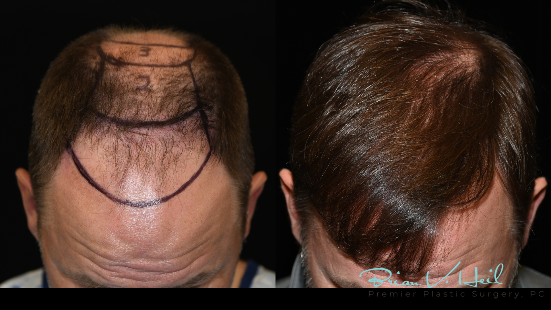 Hair Restoration Before and After | Premier Plastic Surgery