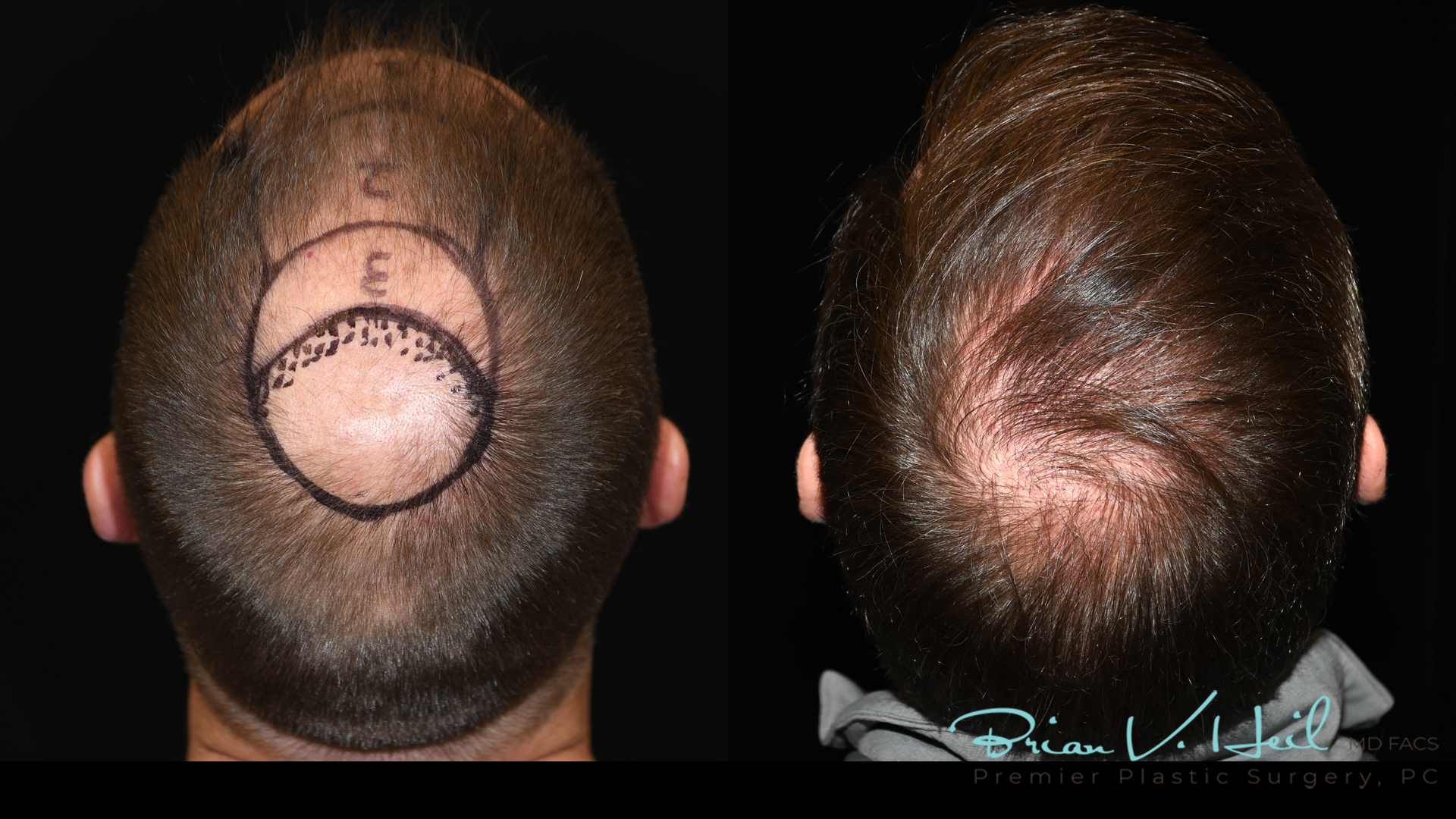 Hair Restoration Before and After | Premier Plastic Surgery