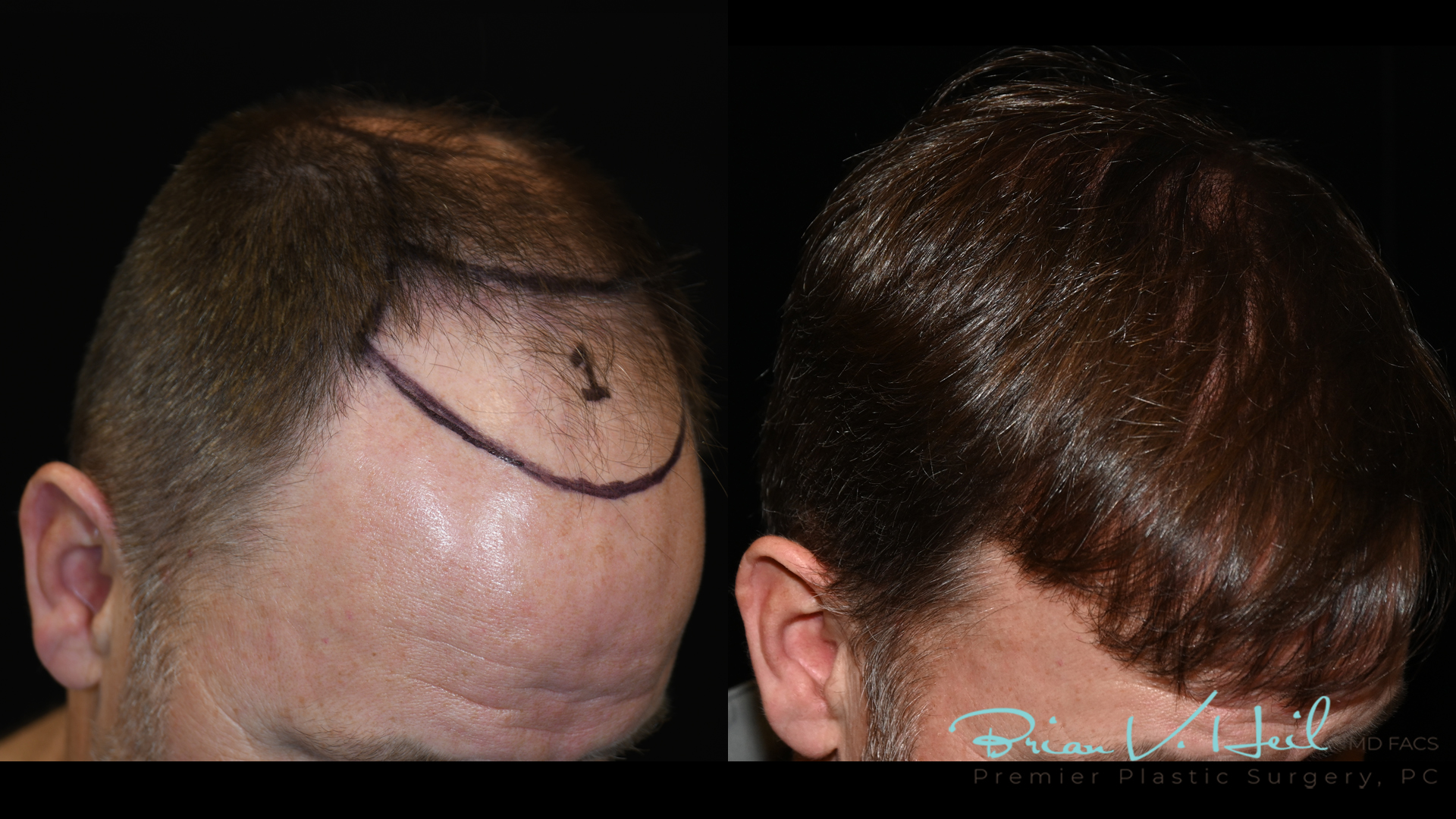 Hair Restoration Before and After | Premier Plastic Surgery