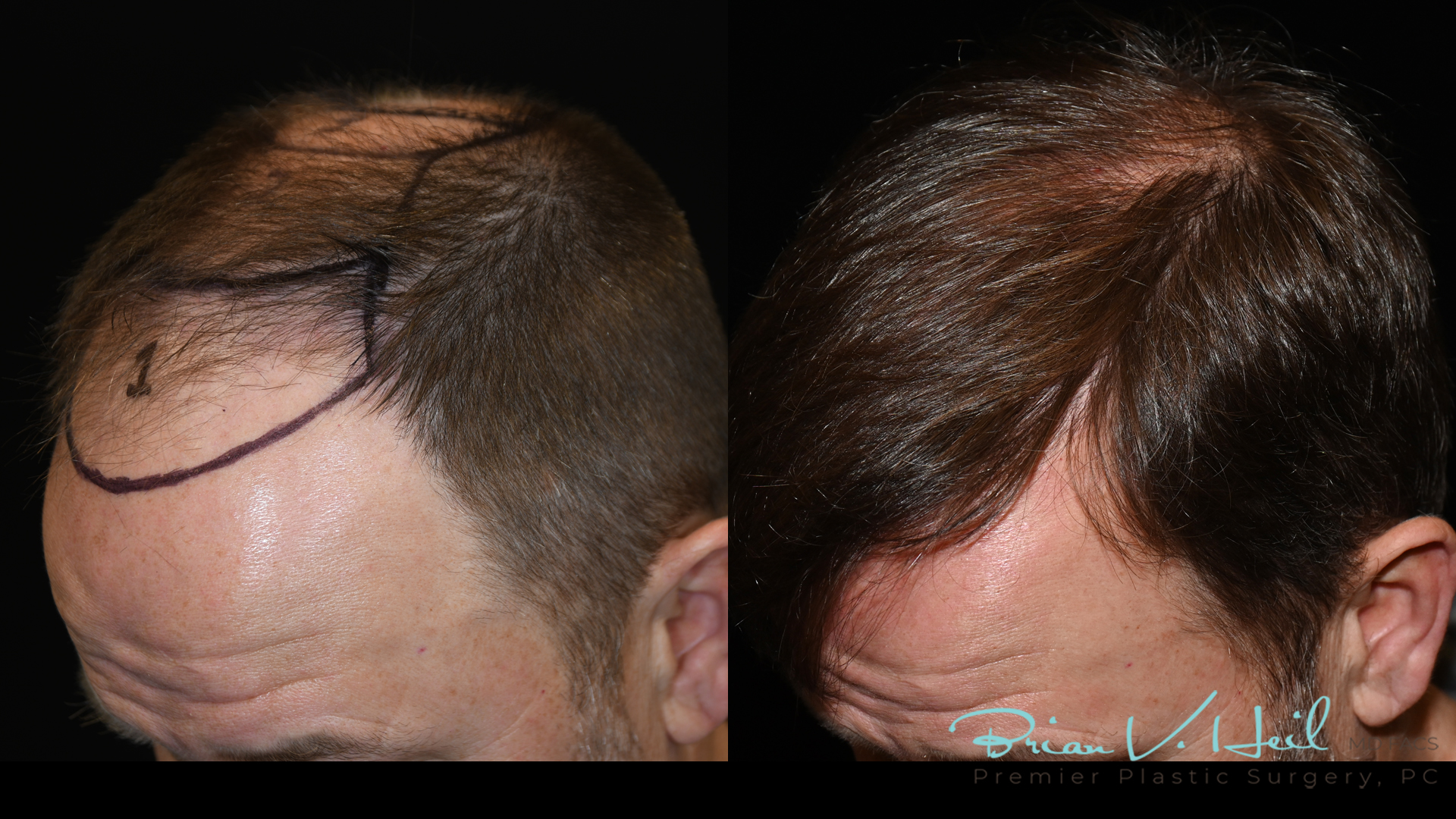 Hair Restoration Before and After | Premier Plastic Surgery