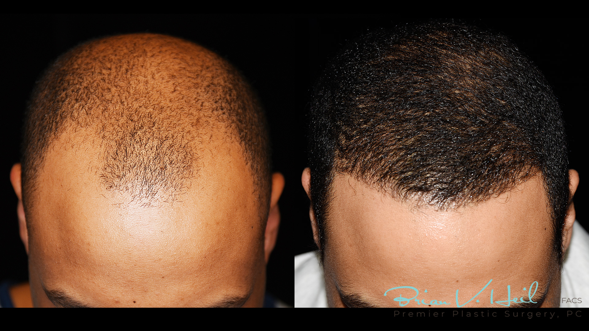 Hair Restoration Before and After | Premier Plastic Surgery