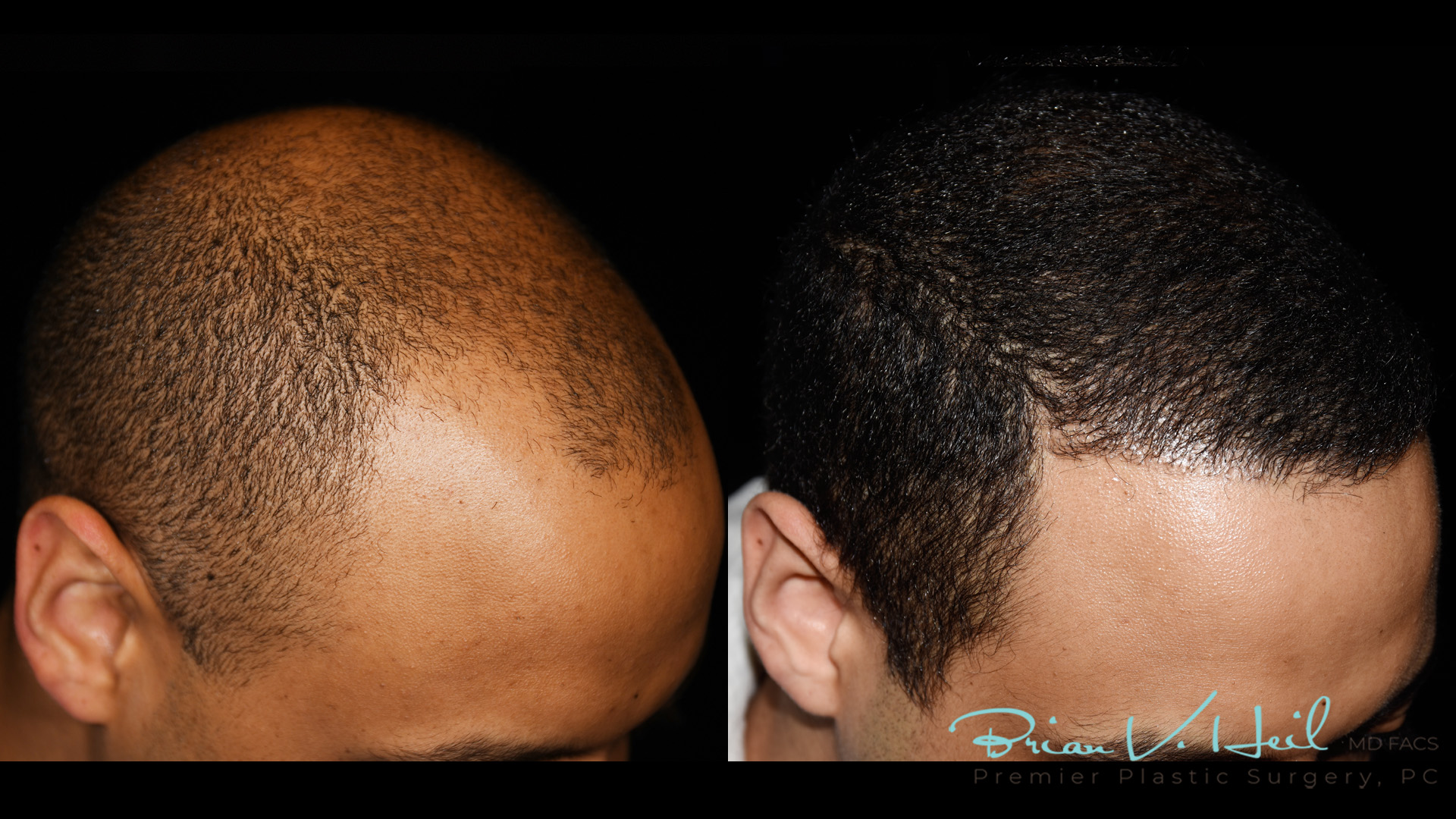 Hair Restoration Before and After | Premier Plastic Surgery