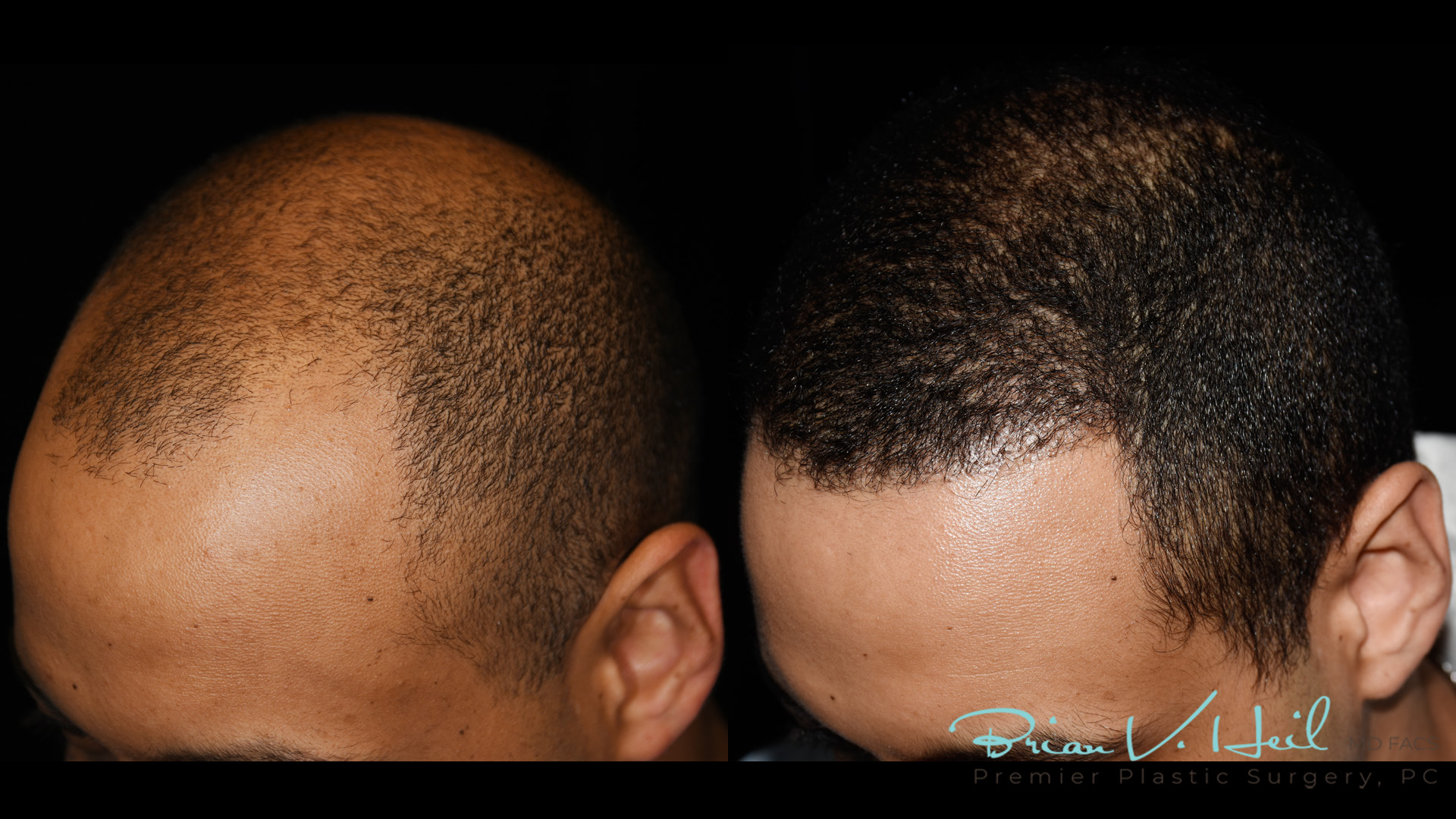 Hair Restoration Before and After | Premier Plastic Surgery