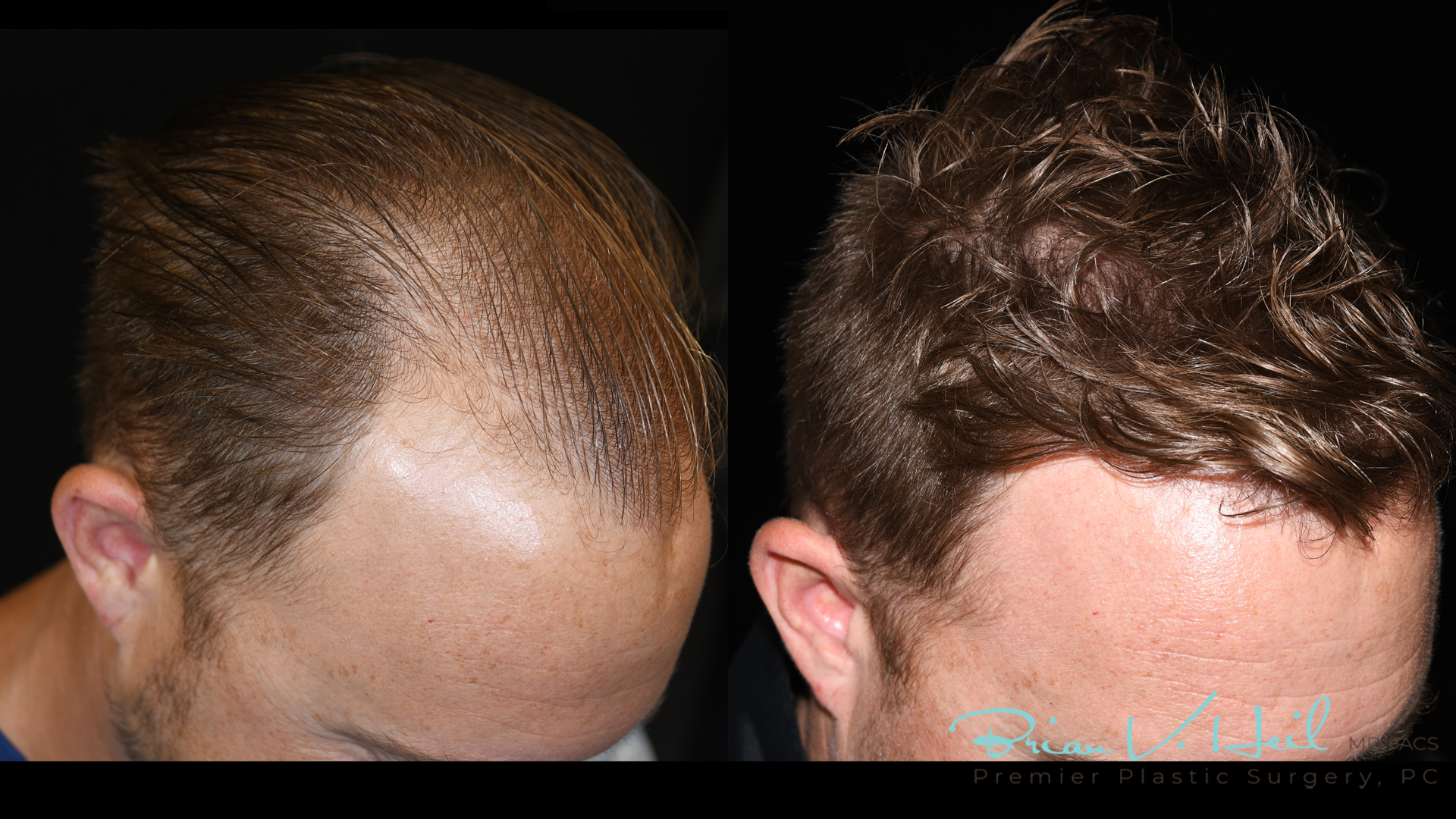 Hair Restoration Before and After | Premier Plastic Surgery