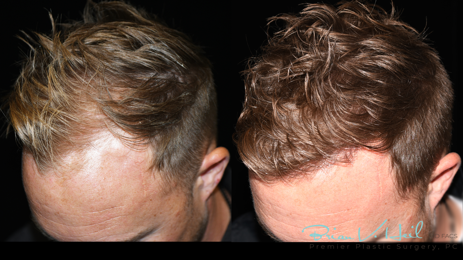 Hair Restoration Before and After | Premier Plastic Surgery