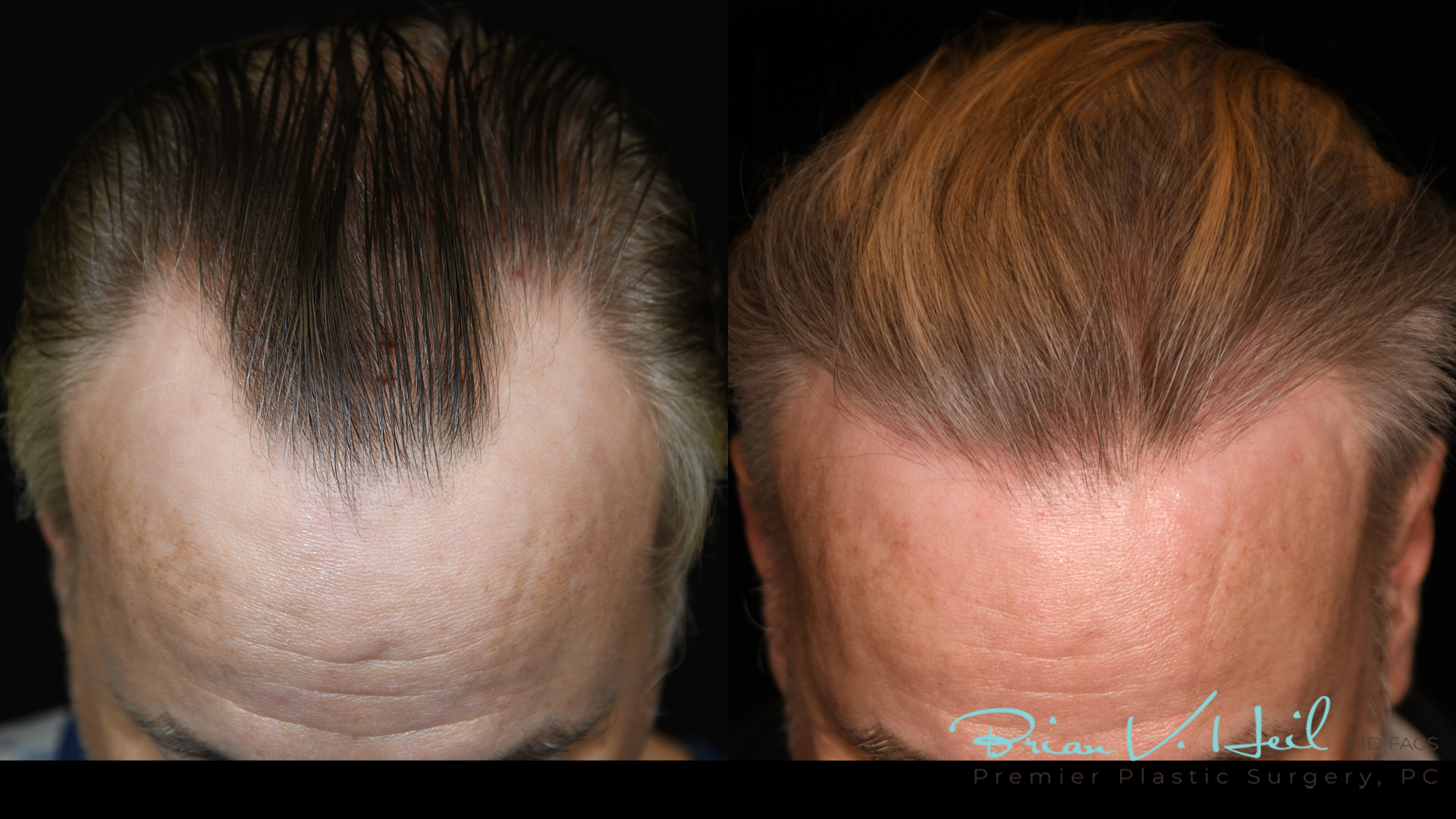 Hair Restoration Before and After | Premier Plastic Surgery