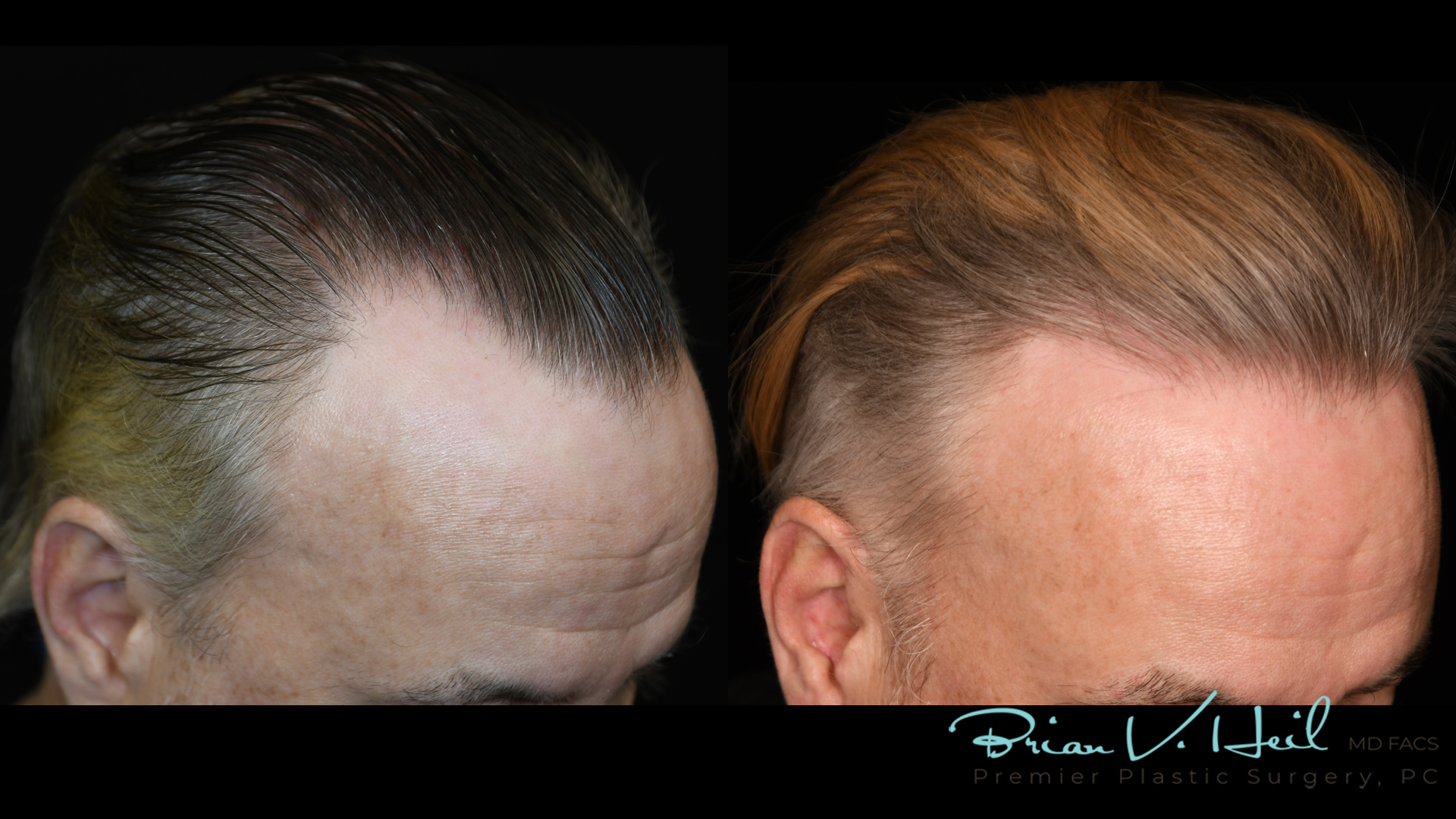 Hair Restoration Before and After | Premier Plastic Surgery